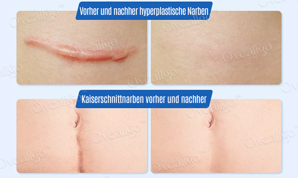 Oveallgo™ SilkScar Narbenbehandlung & Hautreparatur-Serum