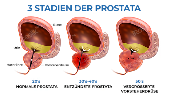 iRosesilk™ MagnaFlow Prostata-Entlastungs-Boxershorts