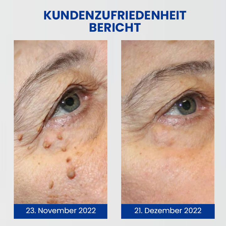 Oveallgo™ Wartsoff Rapid Creme Zur Sofortigen Entfernung Von Hautunreinheiten