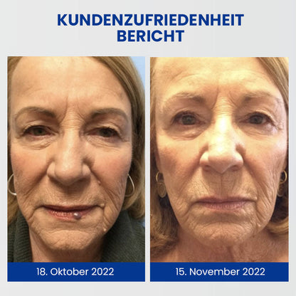 Oveallgo™ Wartsoff Rapid Creme Zur Sofortigen Entfernung Von Hautunreinheiten