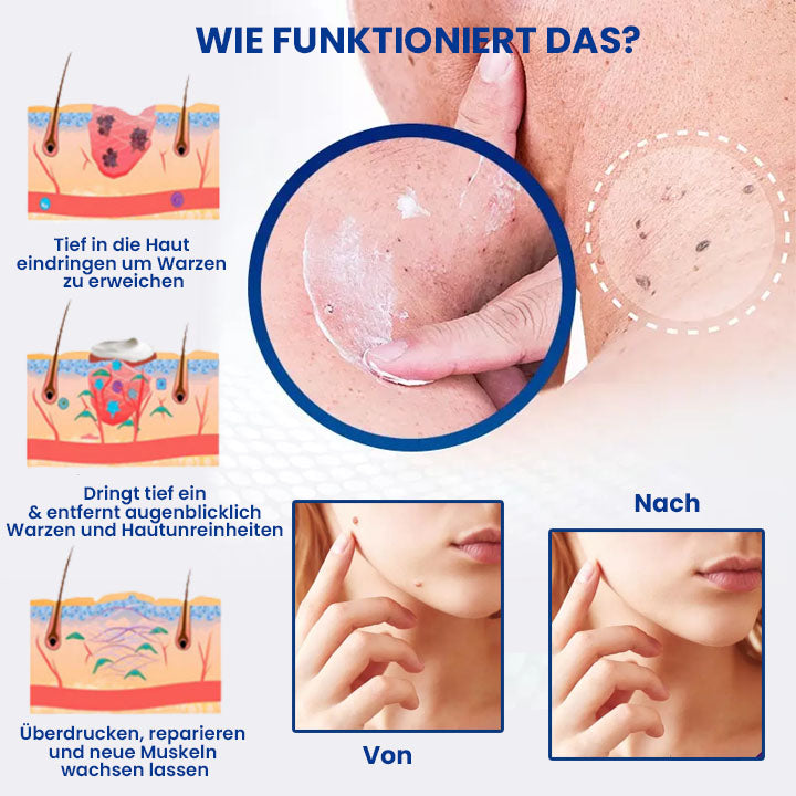 Oveallgo™ Wartsoff Rapid Creme Zur Sofortigen Entfernung Von Hautunreinheiten